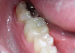 Teeth after with white filings 