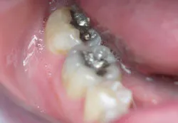 Teeth with silver filings
