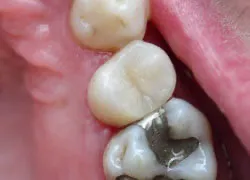 Teeth after with white filings 