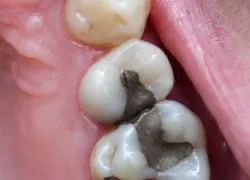 Teeth with silver filings