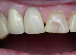 Teeth after with white filings 