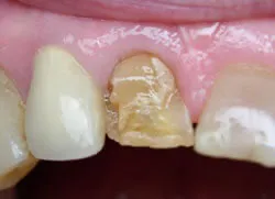 Teeth with silver filings