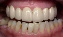 Teeth after with white filings 