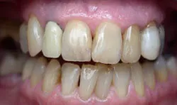 Teeth with silver filings