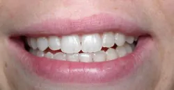 Teeth after with white filings 