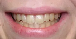 Teeth with silver filings
