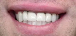 Teeth after with white filings 