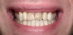 Teeth with silver filings