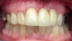 Teeth after with white filings 