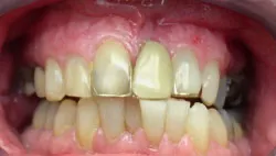 Teeth with silver filings