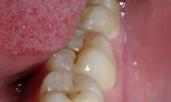 Teeth with silver filings