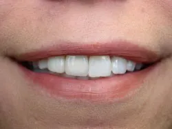 Teeth after with white filings 