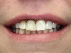 Teeth with silver filings