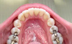 Teeth after with white filings 