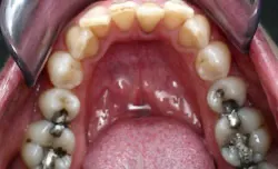 Teeth with silver filings
