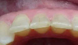 Teeth after with white filings 