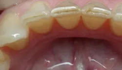 Teeth with silver filings