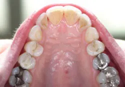 Teeth after with white filings 