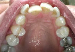Teeth with silver filings