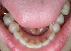 Teeth after with white filings 