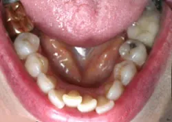 Teeth with silver filings