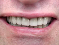 Teeth after with white filings 