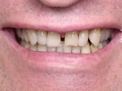 Teeth with silver filings