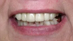 Teeth after with white filings 