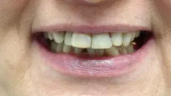 Teeth with silver filings