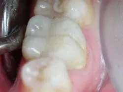 Teeth after with white filings 