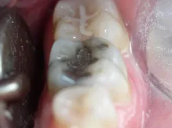 Teeth with silver filings