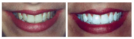 Teeth Whitening